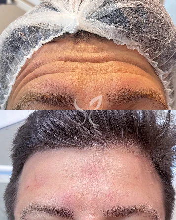 Botox