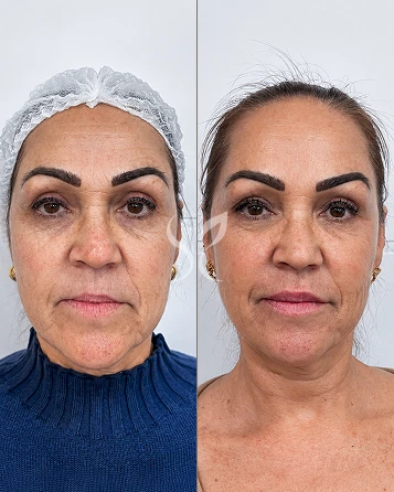 Harmonização Facial