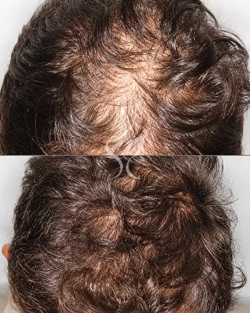 Protocolos Capilares